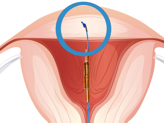 Gynefix Kupferkette in Position